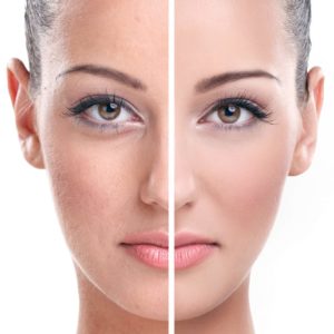 Soin du visage PRP therapy